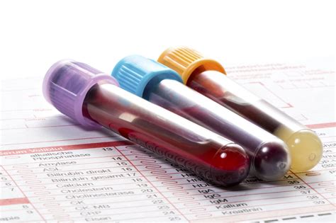 reticulocytes blood test bottle|blood bottle toxicology test.